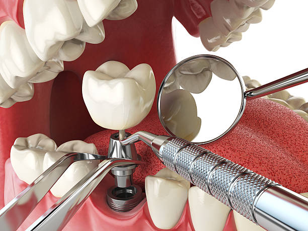 Best Emergency Dentist for Lost Fillings or Crowns in Melrose Park, NY